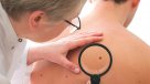 Tus Años Cuentan: Los cuidados para prevenir el cáncer de piel