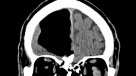 Médicos hallaron un hueco de aire en el cerebro de un hombre