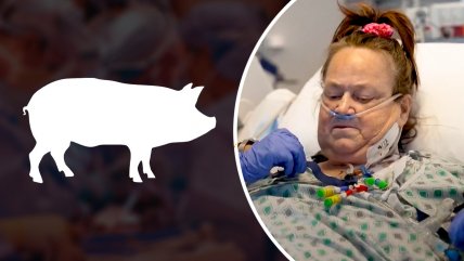   Mujer de 54 años recibió trasplante de bomba cardíaca y riñón de cerdo 