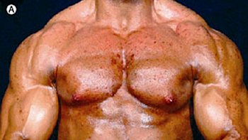 El abuso de testosterona puede generar un tipo de acné grave en el pecho