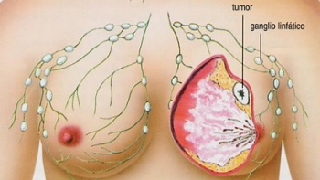 Nuevo tratamiento contra cáncer de mama hereditario aumenta efectividad de quimioterapia
