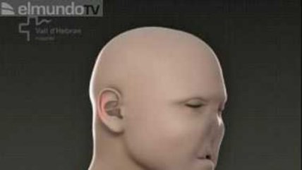   Paciente de primer transplante total de cara inició su recuperación 