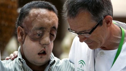   Dan de alta al segundo trasplantado de cara en España 