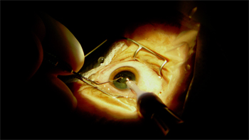   Nuevo método español permite detectar el Alzheimer mediante muestras oculares 