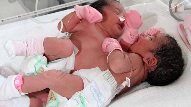 Siamesas separadas duermen con muñecas para no echarse de menos