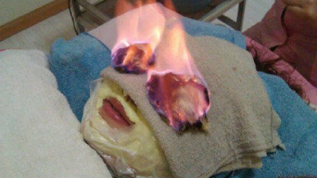 Chinos tratan con fuego las arrugas y la flacidez