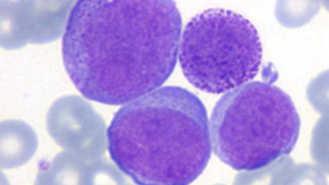 Nueva terapia celular proyecta exterminar la leucemia en ocho días