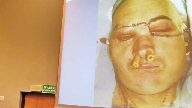 Primer trasplante de rostro en Polonia concluyó positivamente