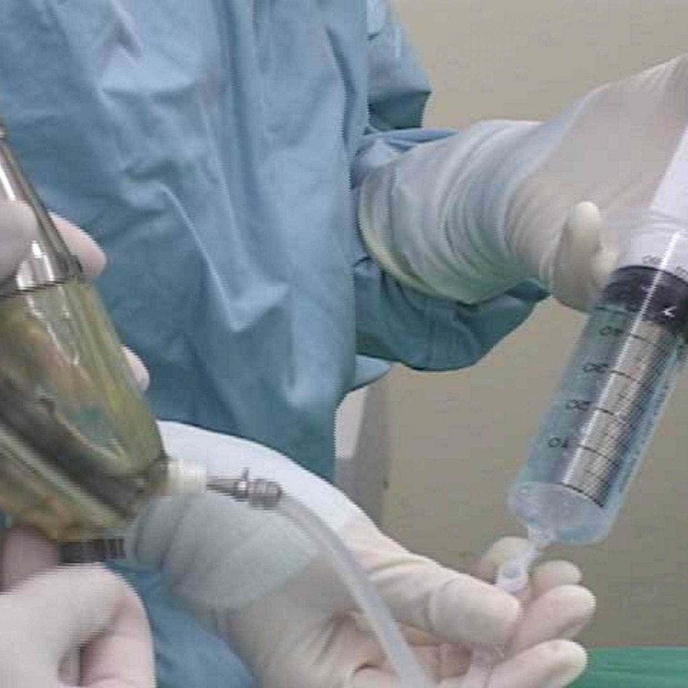 Anciano fue operado tras insertarse tenedor en el pene por 