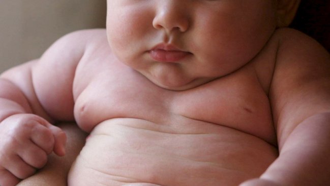 La reducción de estómago a niños puede solucionar la obesidad infantil