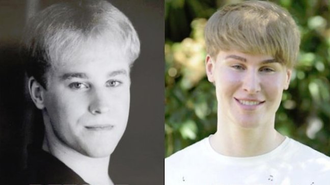 Fan de Justin Bieber se sometió a cirugía para parecerse a su ídolo