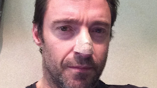 Hugh Jackman reveló en Instagram que padece un carcinoma en la nariz