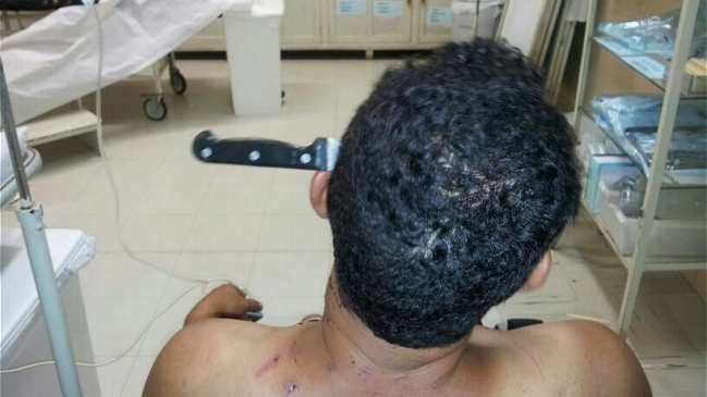 Médicos retiraron un cuchillo clavado en la cabeza de un campesino brasileño