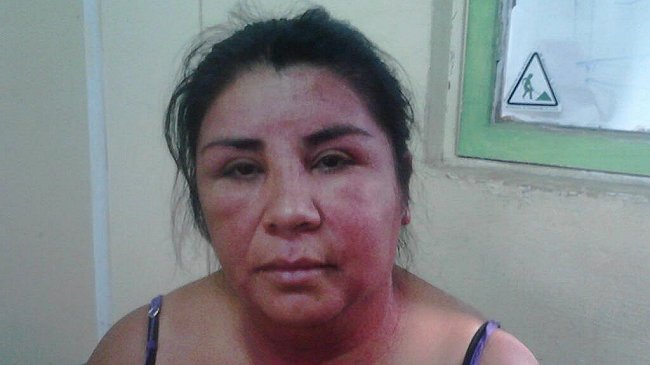 Dirigente mapuche denunció quemaduras por 