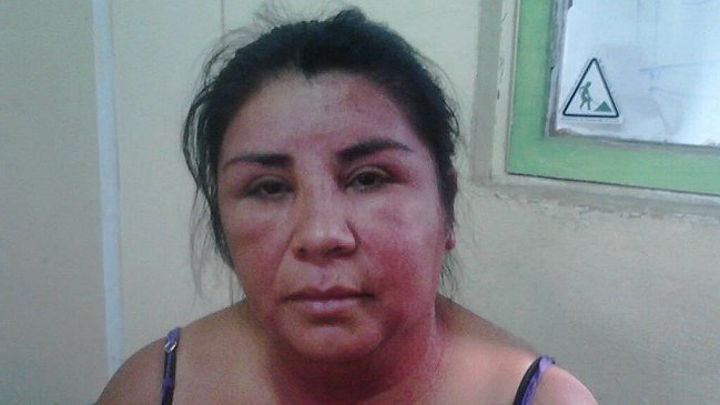 Dirigente mapuche denunció quemaduras por 