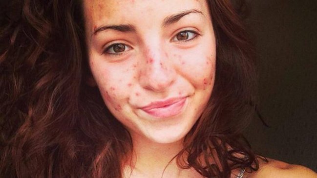 La enfermedad que hace que no puedas dejar de pellizcarte