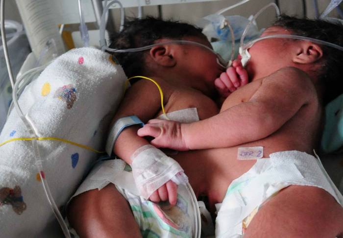 Joven dio a luz a siamesas unidas por el corazón e hígado