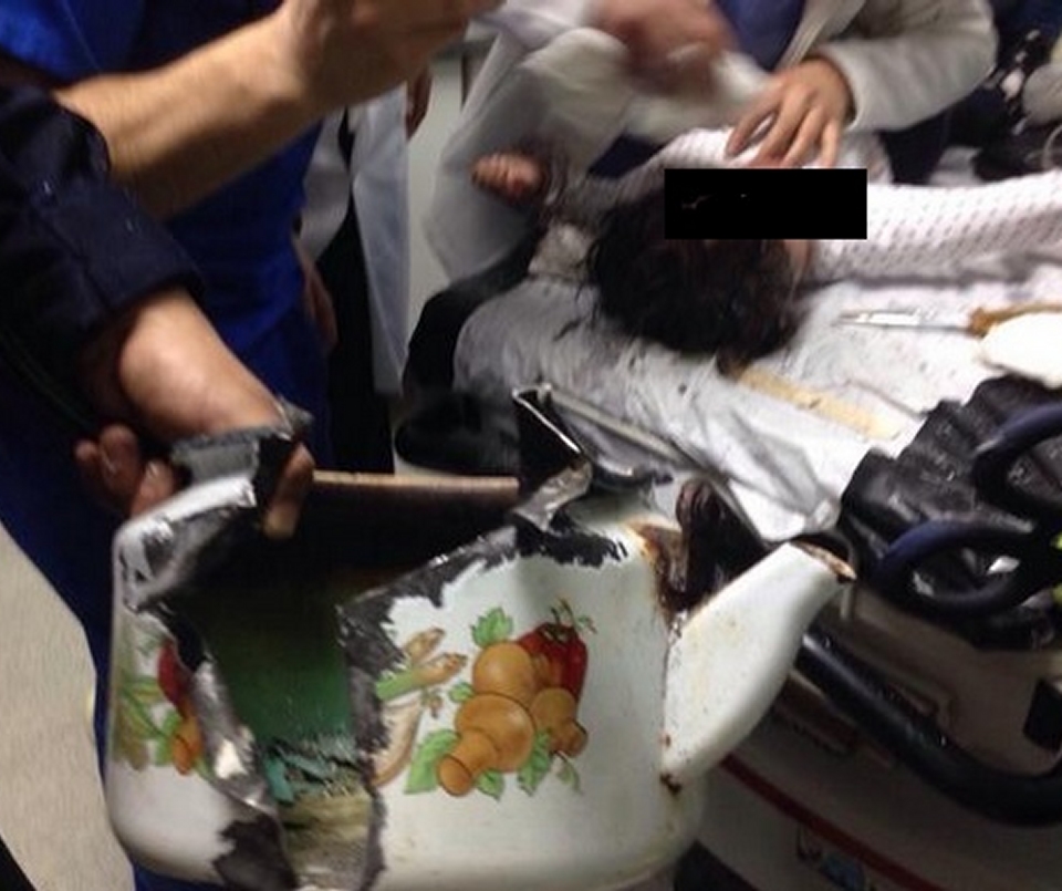 Niña permaneció horas con la cabeza atorada en una tetera