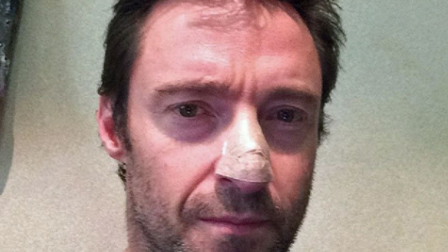 Hugh Jackman enfrenta tercera operación por cáncer de piel