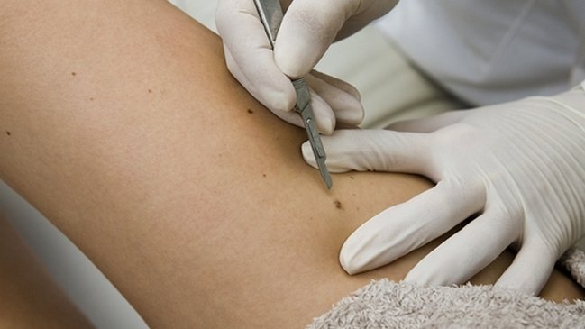 Estudio: Modificación del virus del herpes ayuda a la cura del cáncer de piel