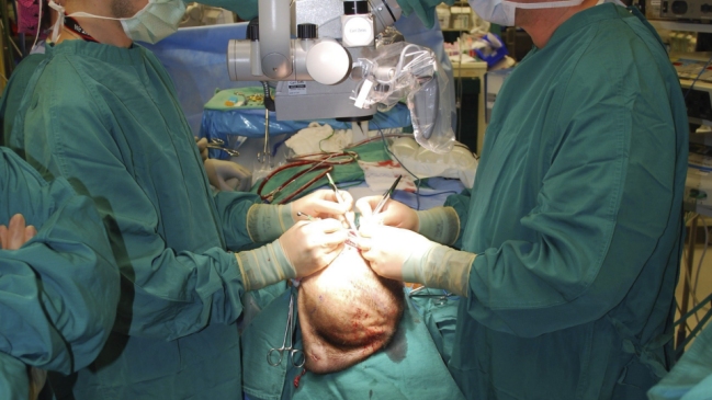 Médicos de Texas realizaron primer trasplante mundial de cráneo y cuero cabelludo