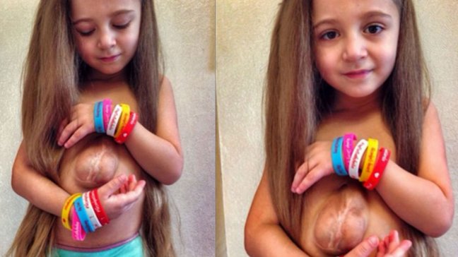 La increíble historia de una niña rusa que vive con el corazón fuera de su pecho