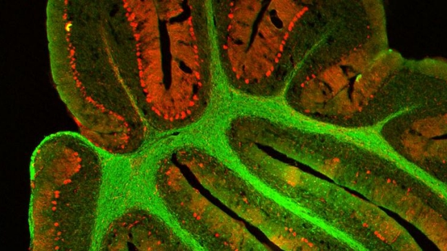 Un estudio en EE.UU. abre la puerta a curar un tipo de leucemia