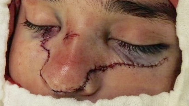 Carabinero sufrió grave corte en la cara al hacer arreglos en dependencias policiales