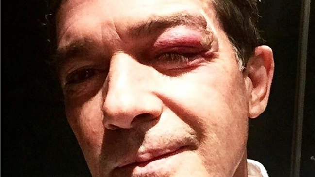 Antonio Banderas sufre accidente en pleno rodaje