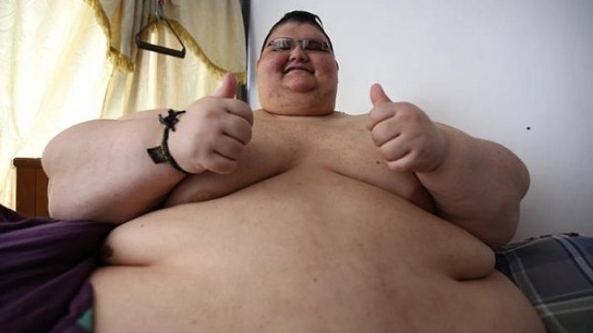 El hombre más obeso del mundo será operado tras bajar 175 kilos