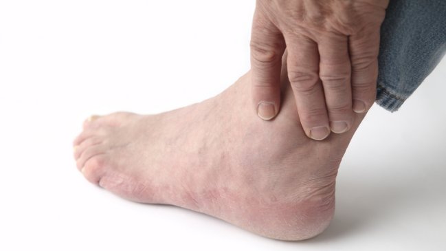 Este sábado se realizará el primer seminario sobre hiperuricemia en Chile