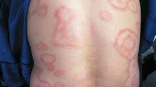 Minsal consigna cinco casos de lepra en los últimos 10 años