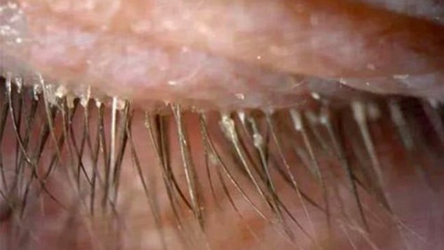 Encuentran más de cien parásitos en pestañas de una mujer