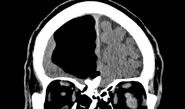 Médicos hallaron un hueco de aire en el cerebro de un hombre