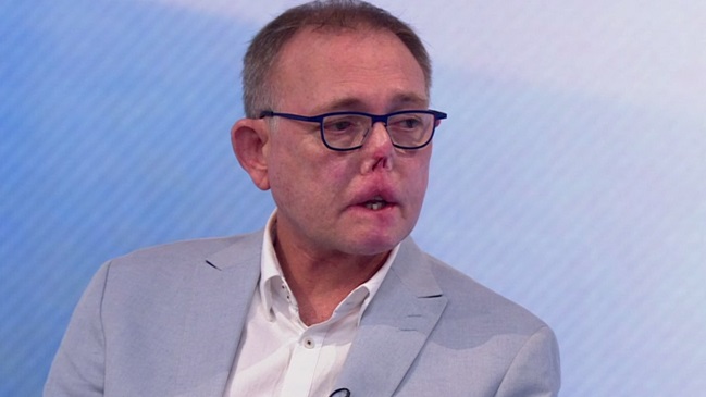 Hombre perdió ambas piernas y parte de su cara por un arañazo y lengüetazo de su perro