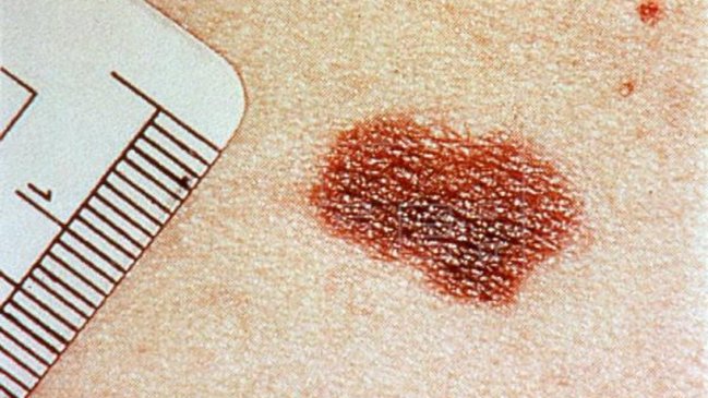 Crean el primer análisis de sangre que detecta melanomas en sus primeras fases