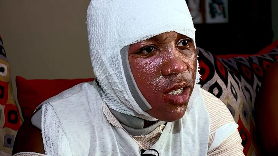 Reto viral del agua hirviendo dejó a joven con graves quemaduras