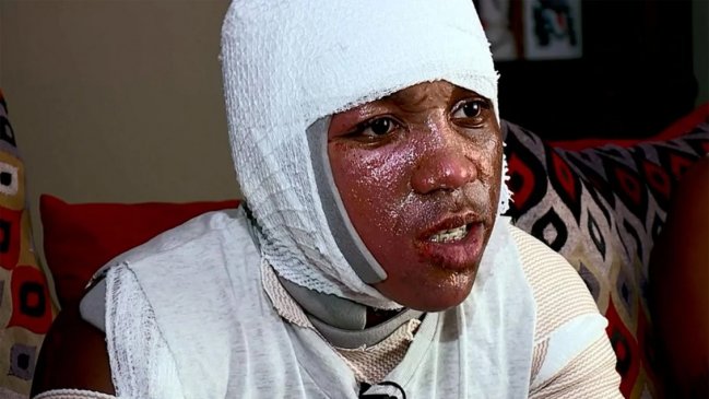 Reto viral del agua hirviendo dejó a joven con graves quemaduras