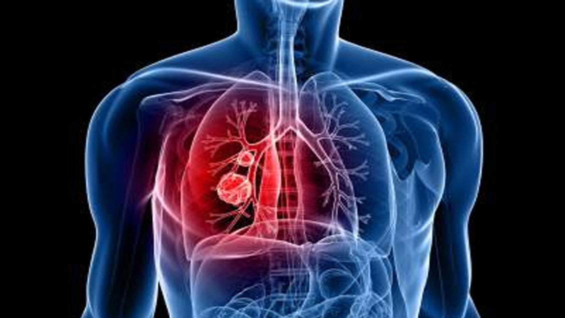 Científicos descubrieron proteínas clave asociadas al cáncer de pulmón