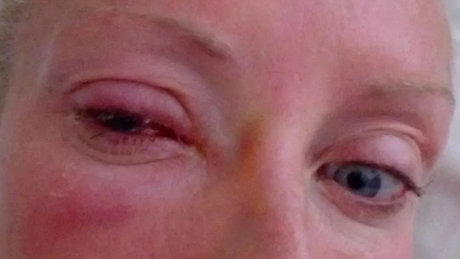 Mujer quedó ciega por parásito que la atacó en la ducha