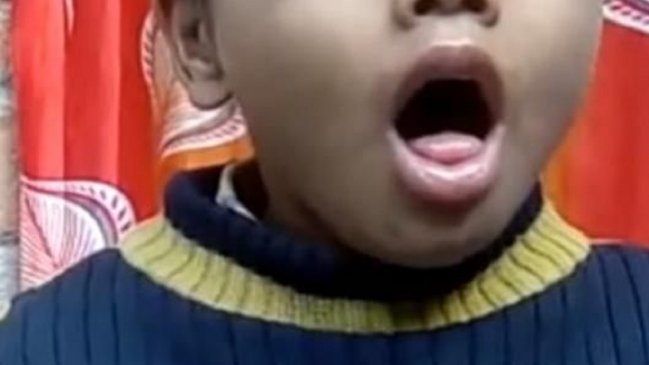 Niño se tragó un pito y su tos se volvió viral