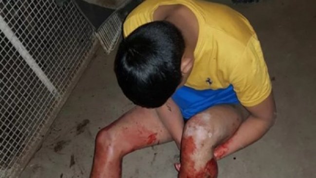 Ladrón quiso robar en casa de anciana y un pitbull le destrozó la pierna