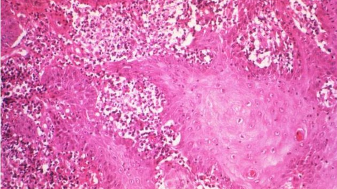 Mujer se contagió con extraña bacteria que le 