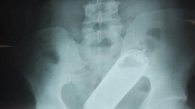 Extraen frasco de perfume del recto de un hombre en Honduras