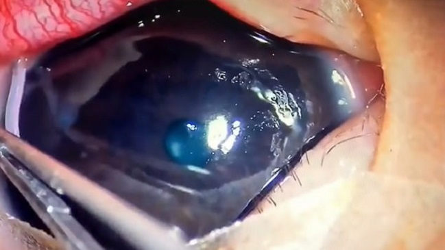 Encuentran 11 lombrices en el ojo de un bebé en China