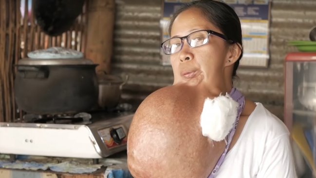 Mujer pensó que tenía un simple dolor de muela pero desarrolló un tumor gigante