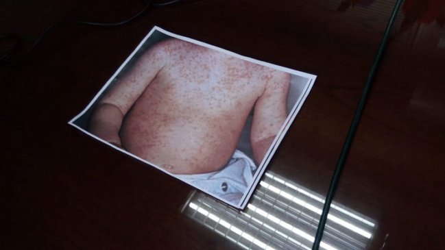 Subsecretaria de Salud: Posibilidades de que el sarampión se expanda son bastante pocas