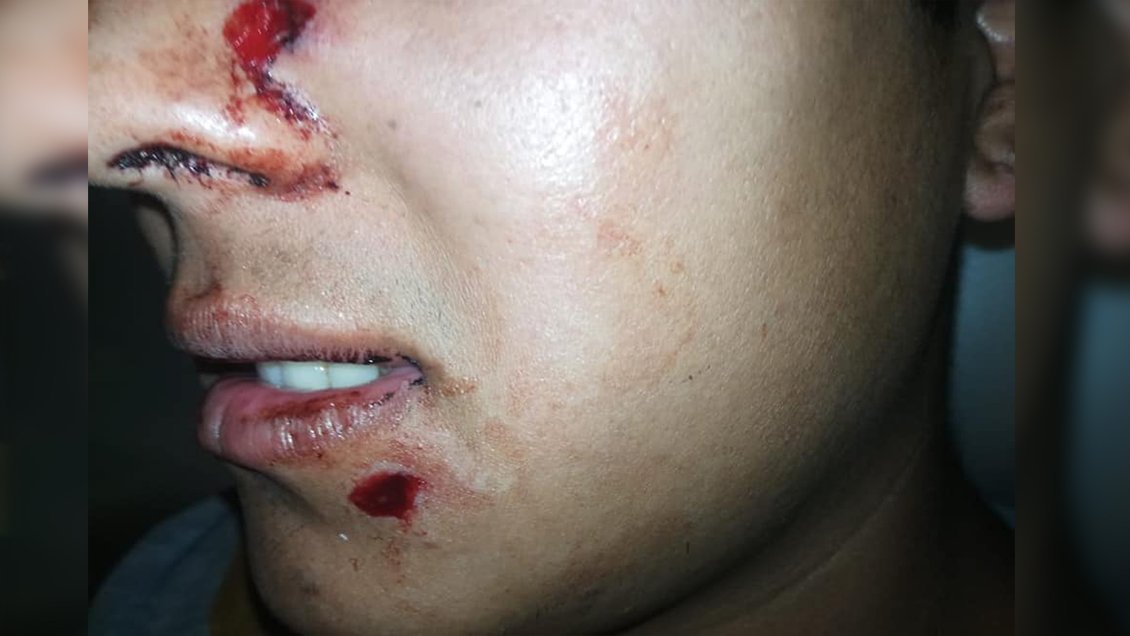 Padre Las Casas: Adolescente fue herido con perdigones en el rostro durante incidentes