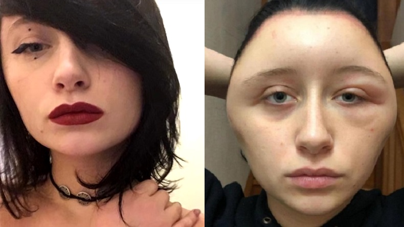 Joven sufrió deformación de su cara tras teñirse el cabello: 