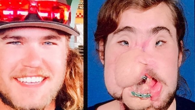 El impresionante cambio de un joven gracias a trasplante de cara: Había intentado suicidarse